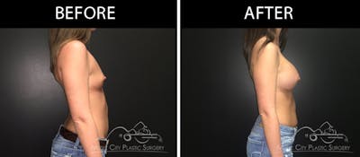 Breast Augmentation Before & After Gallery - Patient 90709299 - Image 3