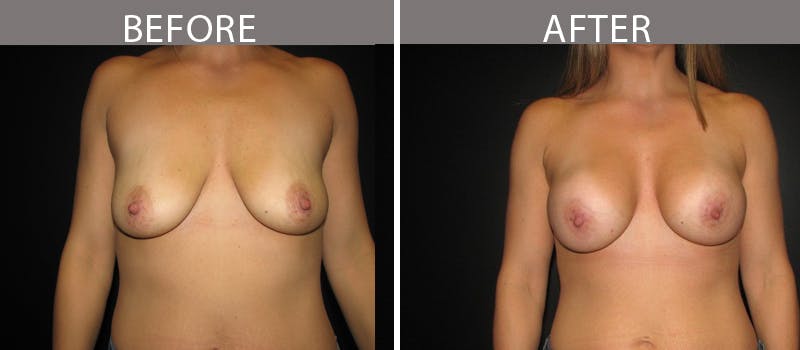Breast Augmentation Before & After Gallery - Patient 90709306 - Image 1