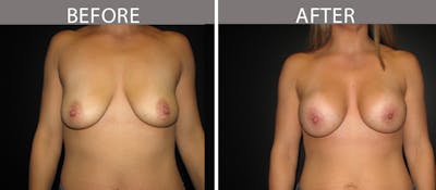 Breast Augmentation Before & After Gallery - Patient 90709306 - Image 1