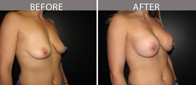 Breast Augmentation Before & After Gallery - Patient 90709306 - Image 2