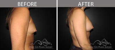 Breast Augmentation Before & After Gallery - Patient 90709306 - Image 3