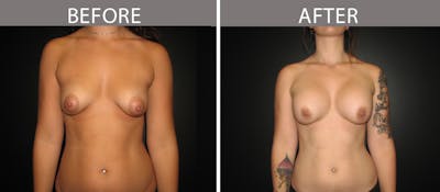 Breast Augmentation Before & After Gallery - Patient 90709313 - Image 1