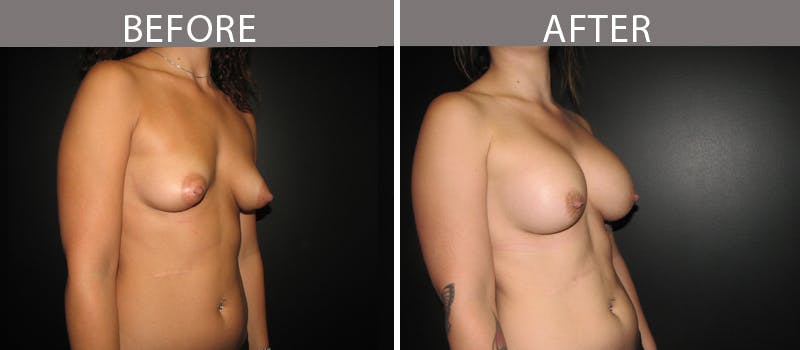 Breast Augmentation Before & After Gallery - Patient 90709313 - Image 2