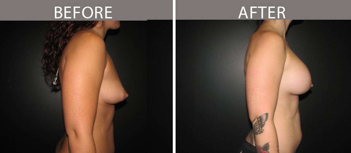 Breast Augmentation Before & After Gallery - Patient 90709313 - Image 3