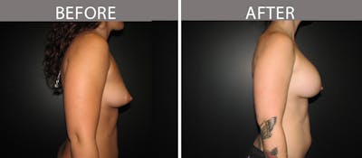 Breast Augmentation Before & After Gallery - Patient 90709313 - Image 3