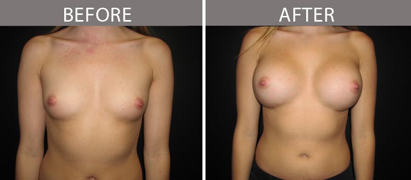 Breast Augmentation Before & After Gallery - Patient 90709326 - Image 1