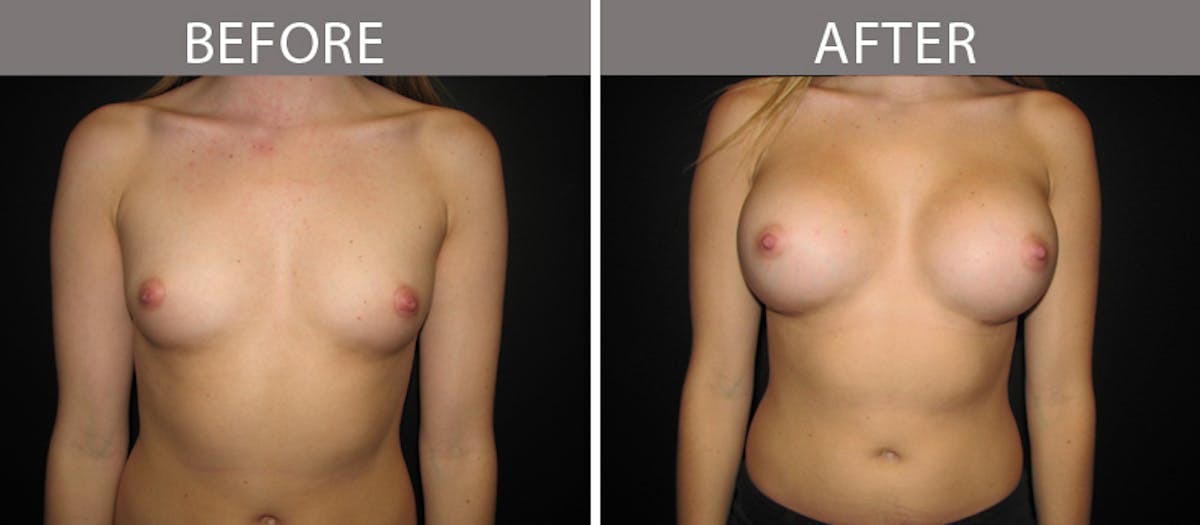 Breast Augmentation Before & After Gallery - Patient 90709326 - Image 1
