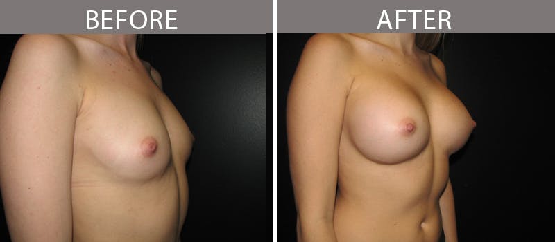 Breast Augmentation Before & After Gallery - Patient 90709326 - Image 2