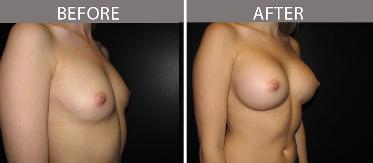 Breast Augmentation Before & After Gallery - Patient 90709326 - Image 2