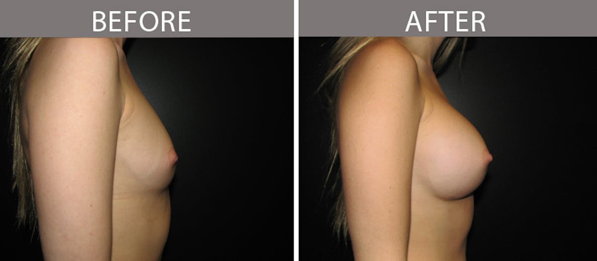 Breast Augmentation Before & After Gallery - Patient 90709326 - Image 3