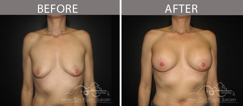 Breast Augmentation Before & After Gallery - Patient 90709336 - Image 1