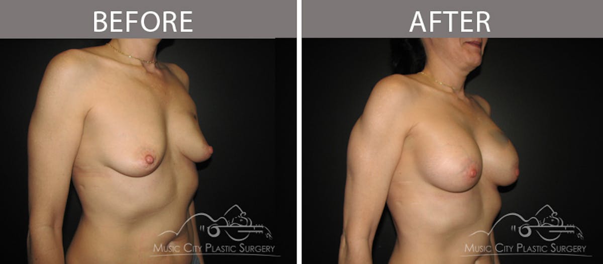 Breast Augmentation Before & After Gallery - Patient 90709336 - Image 2