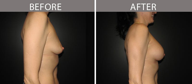 Breast Augmentation Before & After Gallery - Patient 90709336 - Image 3
