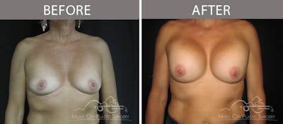Breast Augmentation Before & After Gallery - Patient 90709341 - Image 1