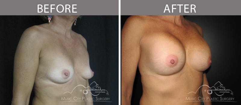 Breast Augmentation Before & After Gallery - Patient 90709341 - Image 2