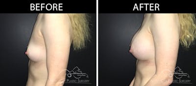 Breast Augmentation Before & After Gallery - Patient 90709349 - Image 3