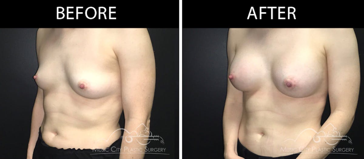 Breast Augmentation Before & After Gallery - Patient 90709349 - Image 2