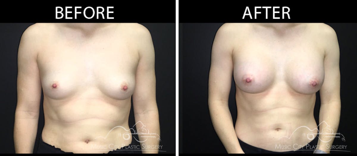 Breast Augmentation Before & After Gallery - Patient 90709349 - Image 1