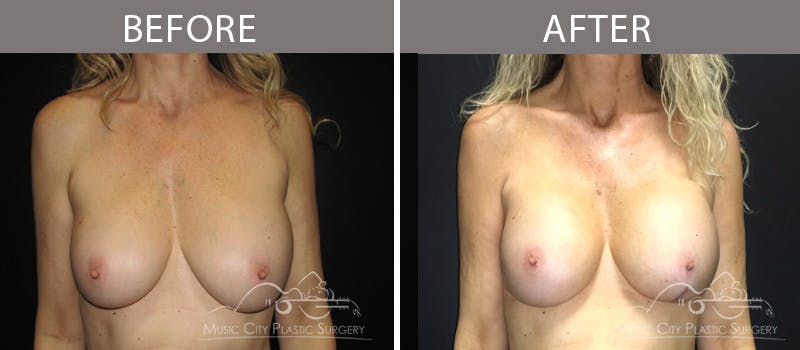 Breast Augmentation Before & After Gallery - Patient 90709351 - Image 1