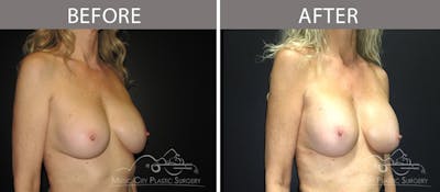 Breast Augmentation Before & After Gallery - Patient 90709351 - Image 2