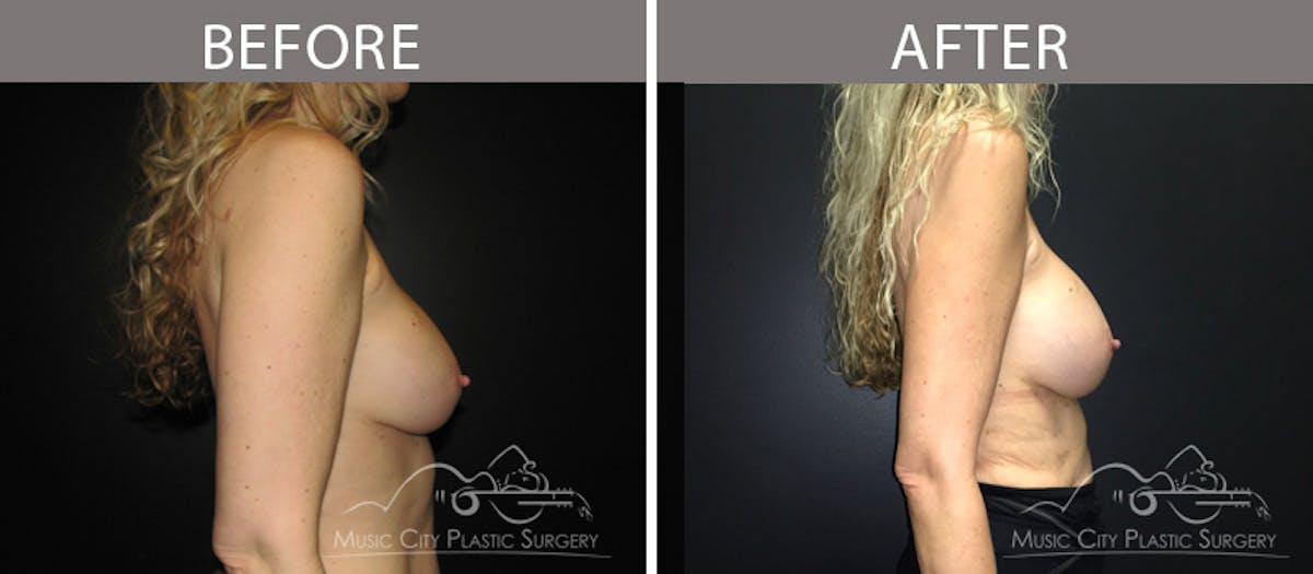 Breast Augmentation Before & After Gallery - Patient 90709351 - Image 3