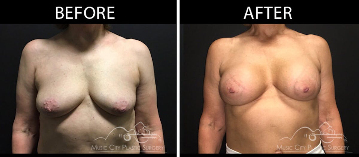 Breast Lift with Augmentation Before & After Gallery - Patient 161426412 - Image 1