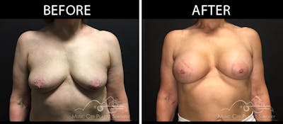 Breast Lift with Augmentation Before & After Gallery - Patient 161426412 - Image 1