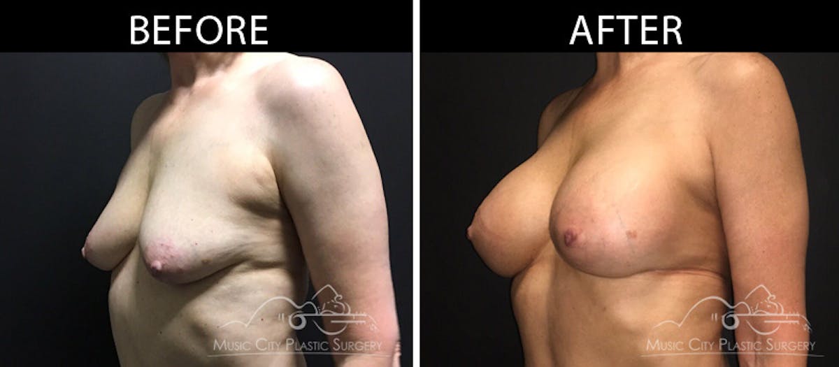 Breast Lift with Augmentation Before & After Gallery - Patient 161426412 - Image 2
