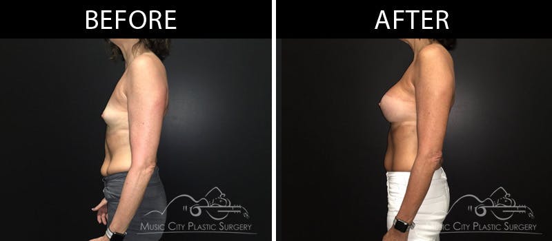 Breast Augmentation Before & After Gallery - Patient 90709361 - Image 3