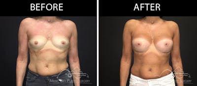 Breast Augmentation Before & After Gallery - Patient 90709361 - Image 1