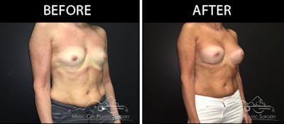 Breast Augmentation Before & After Gallery - Patient 90709361 - Image 2