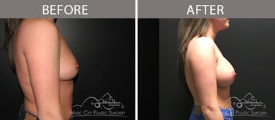 Breast Augmentation Before & After Gallery - Patient 90709363 - Image 3