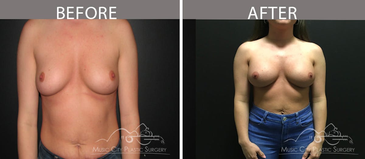 Breast Augmentation Before & After Gallery - Patient 90709363 - Image 1