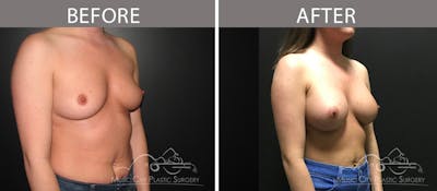 Breast Augmentation Before & After Gallery - Patient 90709363 - Image 2