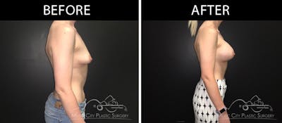 Breast Augmentation Before & After Gallery - Patient 90709369 - Image 3