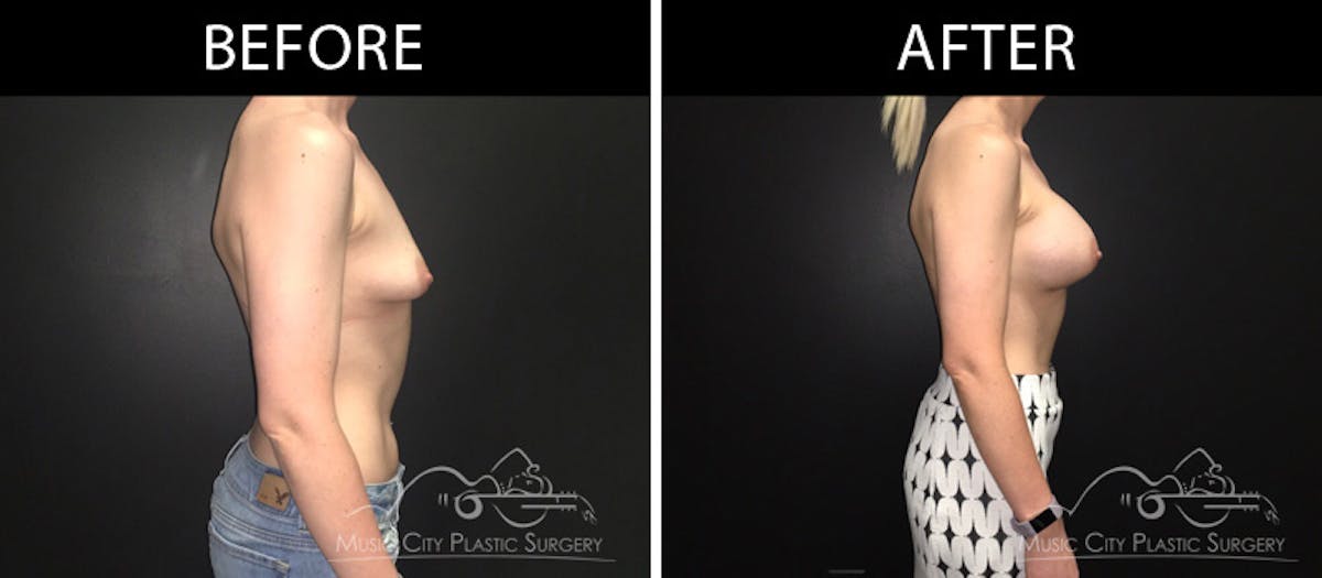 Breast Augmentation Before & After Gallery - Patient 90709369 - Image 3