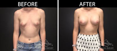 Breast Augmentation Before & After Gallery - Patient 90709369 - Image 1