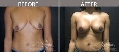Breast Augmentation Before & After Gallery - Patient 90709372 - Image 1