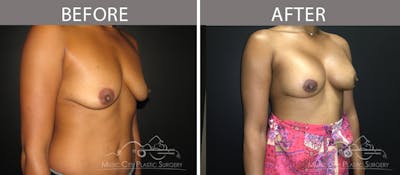 Breast Augmentation Before & After Gallery - Patient 90709372 - Image 2