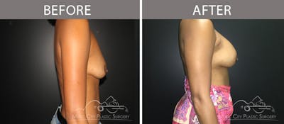 Breast Augmentation Before & After Gallery - Patient 90709372 - Image 3