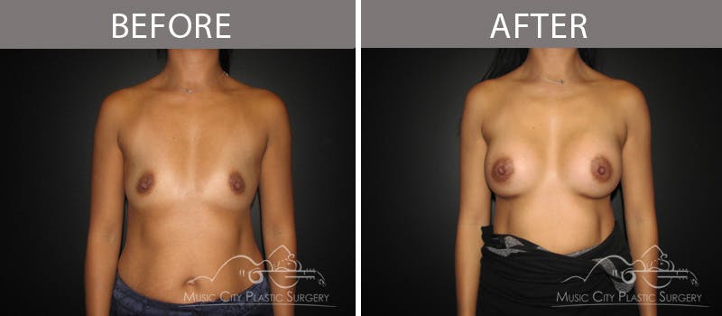 Breast Augmentation Before & After Gallery - Patient 90709373 - Image 1