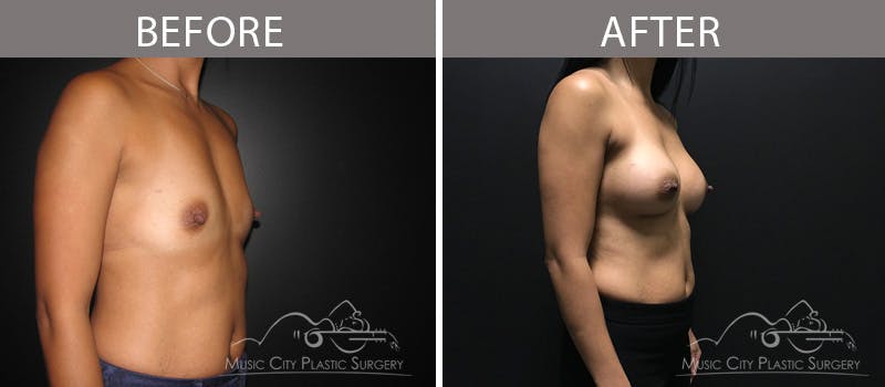 Breast Augmentation Before & After Gallery - Patient 90709373 - Image 2