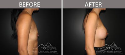 Breast Augmentation Before & After Gallery - Patient 90709373 - Image 3