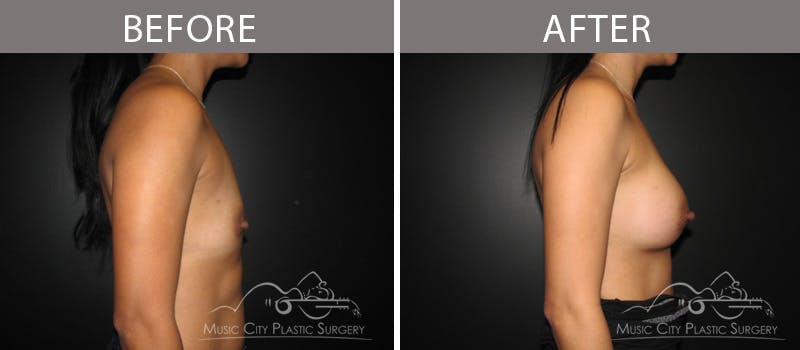 Breast Augmentation Before & After Gallery - Patient 90709373 - Image 3