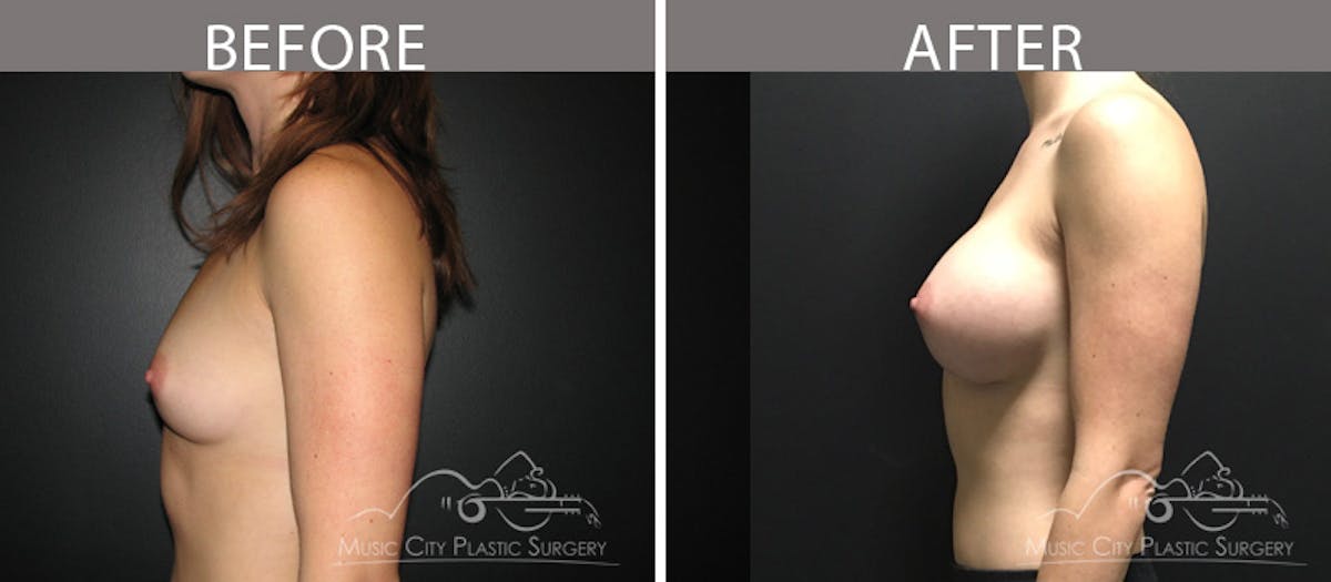 Breast Augmentation Before & After Gallery - Patient 90709383 - Image 4
