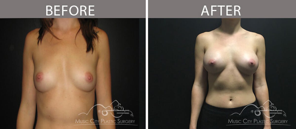 Breast Augmentation Before & After Gallery - Patient 90709383 - Image 1