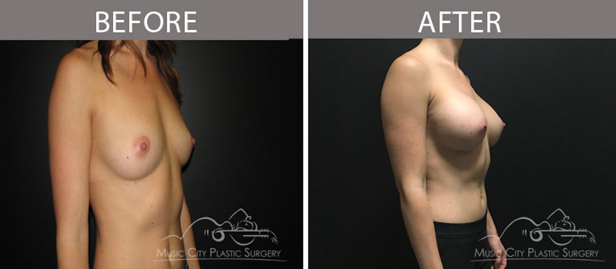Breast Augmentation Before & After Gallery - Patient 90709383 - Image 2