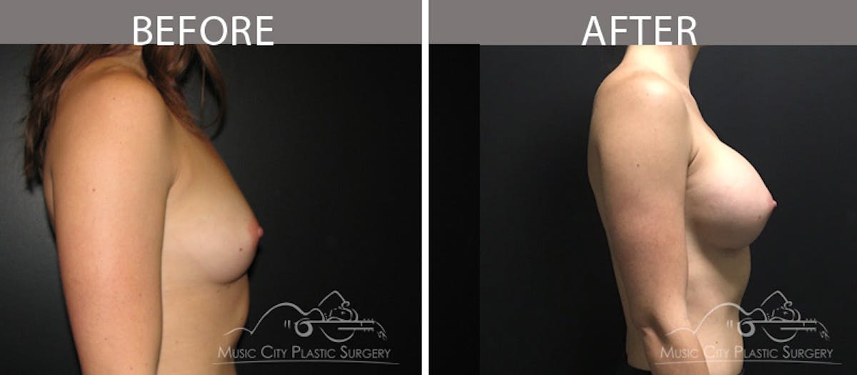 Breast Augmentation Before & After Gallery - Patient 90709383 - Image 3