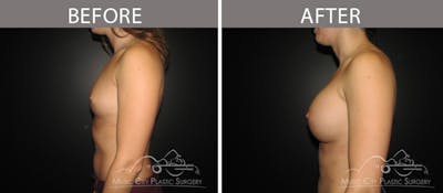 Breast Augmentation Before & After Gallery - Patient 90709384 - Image 3