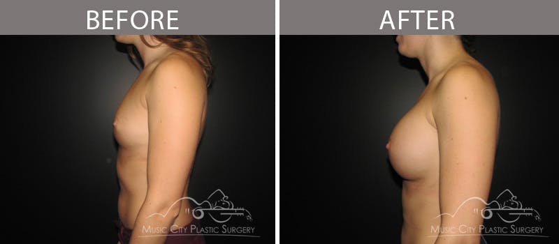 Breast Augmentation Before & After Gallery - Patient 90709384 - Image 3